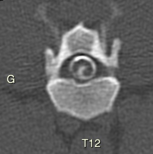 Le myéloscanner présente une fuite de contraste intra-médullaire en T12, un vacuum phenomenon (collection de gaz) en T12-T13 et T13-L1.